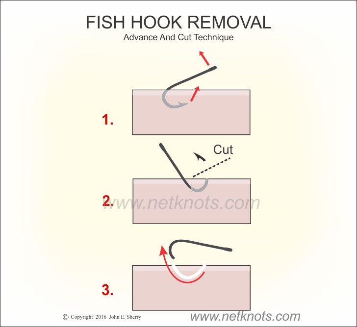 Fish Hook Removal - How to remove a fish hook from skin