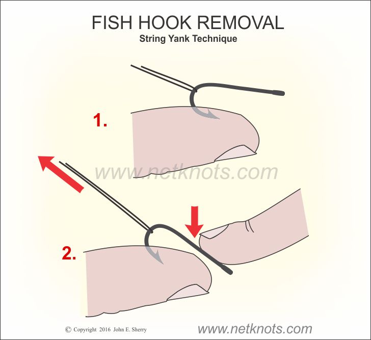 String-pull Method For Removing A Fishhook - Health Library