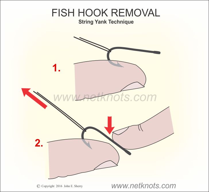 How To Remove A Fish Hook : String Yank Technique 